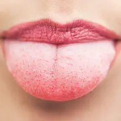 Lingua rosa con puntini rossi, forse un segno di lingua streptococco. Labbra con rossetto scuro.