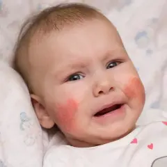 Malutkie dziecko z zaczerwienionymi policzkami, które mogą wskazywać na skazę białkową. Jak rozpoznać te objawy u niemowlaka?