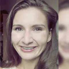 Kiedy trzeba nosić aparat na zęby? Zobacz, co musisz wiedzieć