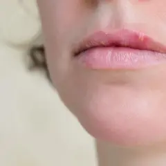 Primo piano delle labbra con una vescicola di herpes che indica perche esce herpes.