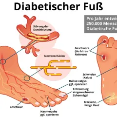 Illustration zeigt einen Fuß mit Anzeichen des diabetischen Fußsyndroms: Geschwüre, Nervenschäden und Durchblutungsstörungen. Ein kleiner Zeh zeigt erste Anzeichen.