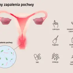 Ilustracja przedstawia przyczyny zapalenia pochwy, w tym cukrzycę, ciasną bieliznę, irygację, środki higieny intymnej, leki, infekcje i zaburzenia hormonalne.