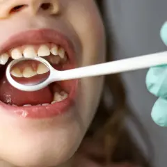 Bocca di un neonato con ciuccio, mentre un dentista esamina i suoi dentini con uno specchietto.