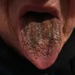 Lingua nera con papille ispessite e macchie scure, come se fosse coperta di terra.