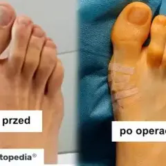 Haluksy: operacja prywatnie czy na NFZ? Pełne koszty i porady
