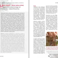 Amfetamina a zęby: Jak rozpoznać i leczyć "meth mouth"?