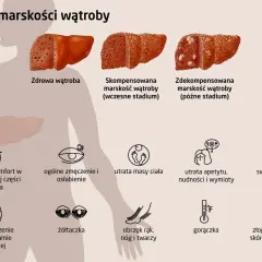 Objawy marskości wątroby: ból brzucha, zmęczenie, utrata masy ciała, żółtaczka, obrzęki, gorączka, swędzenie skóry.