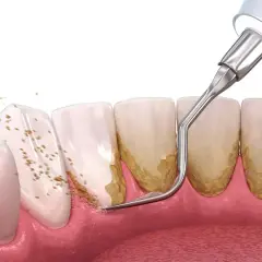 Jak dentysta usuwa kamień nazębny bez bólu i skutecznie?