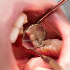 Dziura w zębie? Jak zabezpieczyć ubytek do wizyty u dentysty