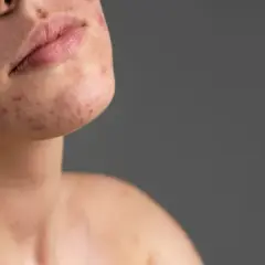 Skóra z widocznymi zmianami trądzikowymi i bliznami atroficznymi na policzku i brodzie.