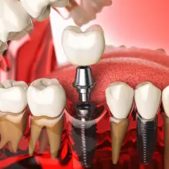 Illustrazione di un impianto perno dente, con la vite inserita nell'osso e la corona in attesa di essere posizionata.
