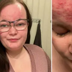 Kvinna med glasögon visar upp sin hud med rodnad och utslag, troligen mild rosacea.