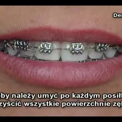 Ile trwa zakładanie aparatu i czy boli? Przewodnik ortodonty
