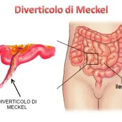 Illustrazione anatomica che mostra un diverticolo di Meckel, una piccola sacca nell'intestino tenue.