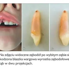 Wypadanie zębów mlecznych u 5 latka: widoczny zębodół po wybitym zębie i uszkodzona warga. Obok wybity ząb w dwóch ujęciach.