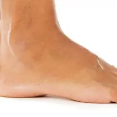 Piede di bambino con osso sporgente esterno, evidenziando la forma del piede.