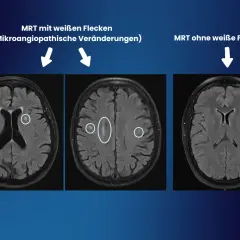 MRT-Aufnahmen zeigen weiße Flecken im Gehirn, die auf mikroangiopathische Veränderungen hindeuten. Diese können fazekas 2 symptome verursachen.