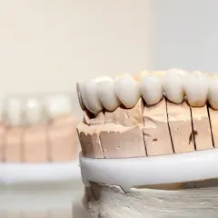 Modelli di denti in porcellana su un supporto in gesso, pronti per essere applicati.