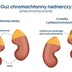 Guz chromochłonny objawy: jak rozpoznać niebezpieczne symptomy