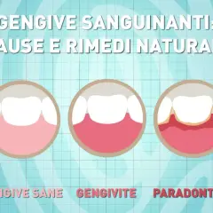 Illustrazione mostra gengive sane, gengivite e parodontite, con la progressione che porta a gengive sanguinanti.