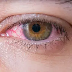 Ojo rojo e irritado, con vasos sanguíneos visibles. Ayuda a entender la diferencia entre conjuntivitis y mocos en los ojos.