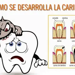 Monstruo atacando un diente triste. Diagramas de etapas de caries dental.