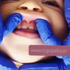 Dłoń w niebieskiej rękawiczce delikatnie rozchyla wargę górną dziecka, ukazując krótkie wędzidełko.