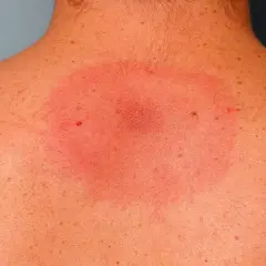 Consecuencias de una garrapata mal quitada en persona y cómo actuar