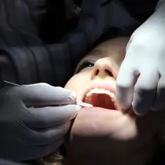 Dentysta w białej rękawiczce wykonuje zabieg zatruwania zęba u pacjentki.