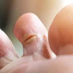 Pieds affectés par une mycose, peut-être contractée à la piscine. La peau entre les orteils est irritée et squameuse.