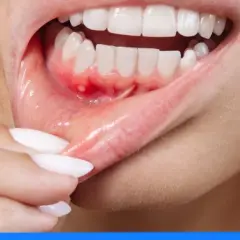Ropa w dziąśle: Jak sobie pomóc i kiedy pilnie do dentysty?