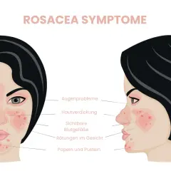Rosacea-Symptome: Rötungen, sichtbare Gefäße, Papeln. Hausmittel können Linderung bringen.