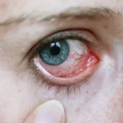 Fibromyalgie Symptome Augen: Unerwartete Beschwerden und Lösungen