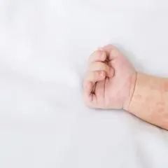 Ręka niemowlaka z zaczerwienioną wysypką. Skóra pokryta jest drobnymi, różowymi plamkami, które mogą świadczyć o alergii lub chorobie.