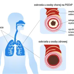 Czy POChP kwalifikuje do renty? Sprawdź, co musisz wiedzieć