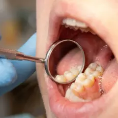 Dentysta bada zęby, szukając oznak infiltracji próchnicy. Widoczne są zęby i lusterko dentystyczne.