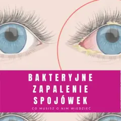Zdrowe oko obok oka z objawami bakteryjnego zapalenia spojówek: zaczerwienienie, obrzęk i wydzielina.