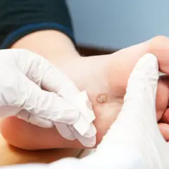 Mani guantate applicano un impacco su una verruca plantare, un rimedio della nonna per le verruche.
