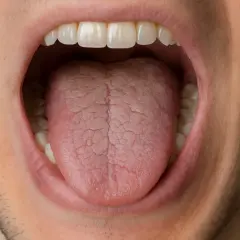 Bocca aperta con lingua che mostra una **lingua asciutta** e screpolata, con denti bianchi visibili.