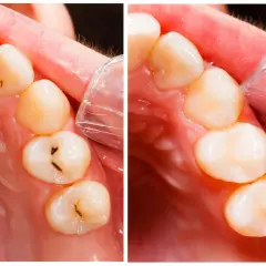 Dientes con caries antes y después del tratamiento. Se observa la mejora en la salud bucal tras la intervención.