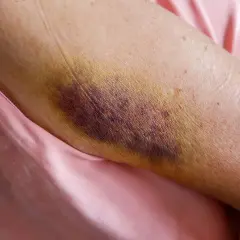 Gros hématome violacé sur un bras, signe d'une jambe en sang suite à un choc. La peau est meurtrie et jaunie par endroits.