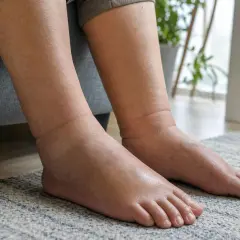 Gambe e piedi gonfi, con evidente caviglia gonfia. La persona è seduta su un divano grigio, con un tappeto a righe sotto i piedi.