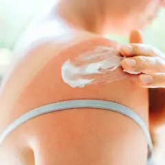 Una mano applica crema doposole su una spalla arrossata dal sole. Utile per lenire e idratare la pelle dopo l'esposizione solare.