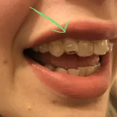 Flecha verde señala un diente donde el **invisalign no encaja**. Se ven los alineadores transparentes en los dientes.