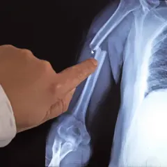 Röntgenbild eines gebrochenen Oberarms. Ein Finger zeigt auf die Bruchstelle. Möglicherweise ein Hinweis auf Knochenkrebs im Alter.