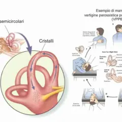 Illustrazione dell'orecchio interno e manovra per le vertigini parossistiche posizionali (VPPB), con i canali semicircolari e i cristalli.