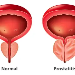 Porównanie pęcherza i prostaty: zdrowa prostata vs. przerost prostaty. Widoczny nacisk na gruczoł krokowy.