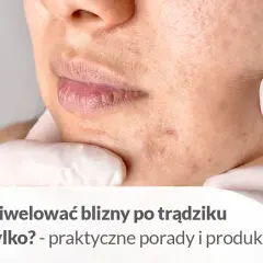Jak usunąć blizny domowym sposobem? Zbliżenie na skórę z widocznymi śladami po trądziku, sugerujące poszukiwanie rozwiązań.