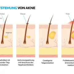 Illustration zeigt, wie entstehen Mitesser: Verhornungsstörung und erhöhte Talgproduktion führen zu verstopften Follikeln, die sich entzünden.