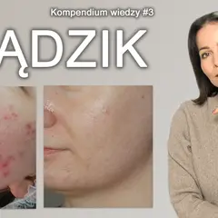 Pryszcze? Poznaj sekrety czystej cery i zapomnij o problemie!